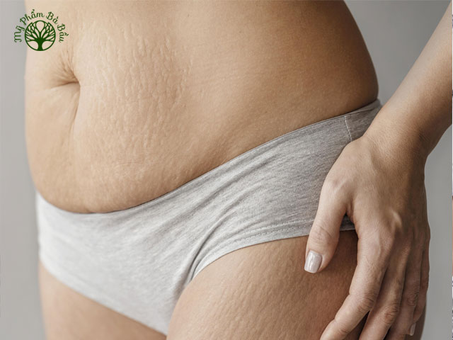 Đa số các mẹ bầu bị rạn da tại các vị trí như vùng ngực, bụng, đùi, bắp chân, sau mông