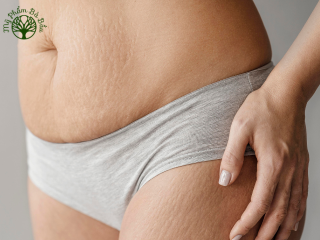 Trong thời gian mang thai các mẹ hay bị rạn da, nên sử dụng các sản phẩm dưỡng sớm để phòng ngừa