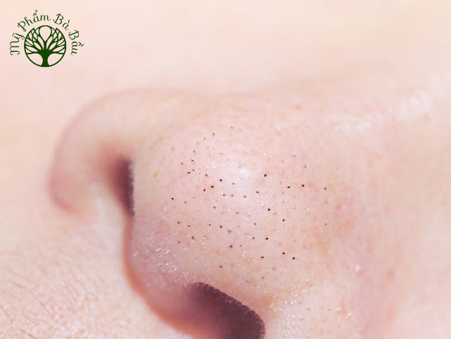 Mụn đầu đen thường tập trung ở vùng mũi, hai bên má và khó điều trị dứt điểm