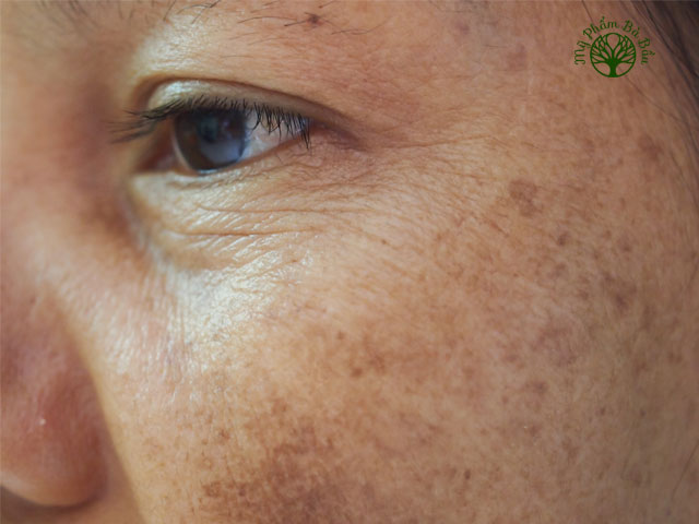Sạm da có thể xuất hiện ở nhiều khu vực và thường đi kèm theo những vết nám