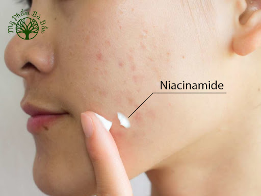 Niacinamide có tác dụng trị thâm, giảm nhờn trên da hiệu quả