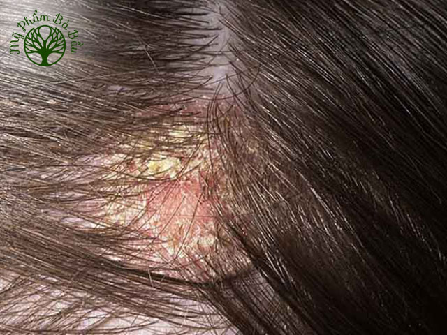 Xuất hiện vảy trắng hoặc các nốt đỏ trên da đầu có thể là dấu hiệu của nấm da đầu