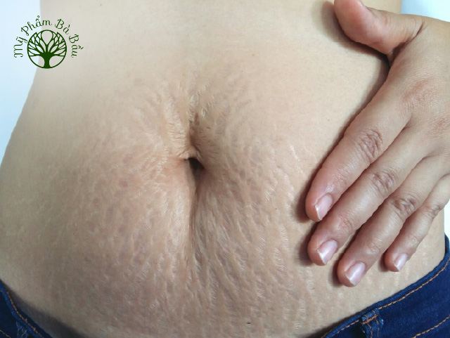 Phụ nữ sau sinh thường có vùng bụng kích thước lớn, xồ xề và nhăn nheo