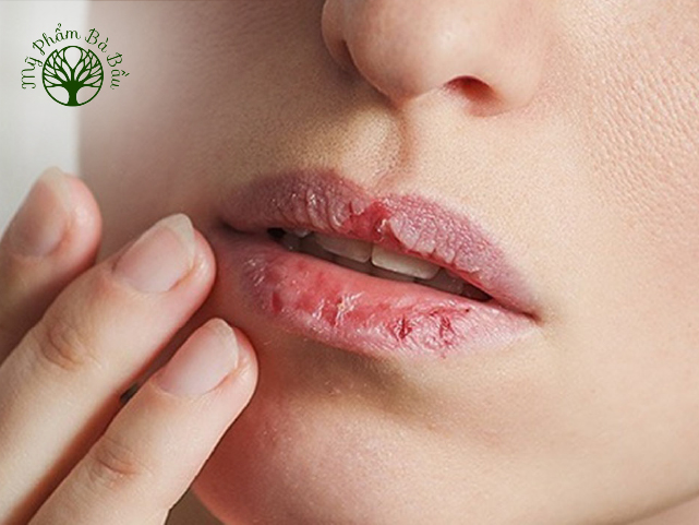 Khô môi là vấn đề thường gặp ở phụ nữ mang thai