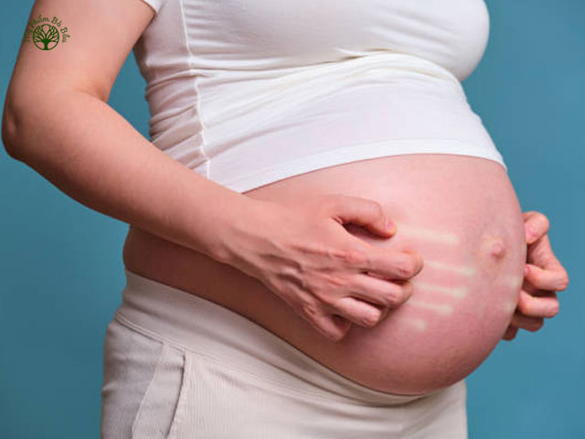 Mẹ bầu thường bị nổi mẩn đỏ, mề đay trong 3 tháng đầu và cuối thai kỳ