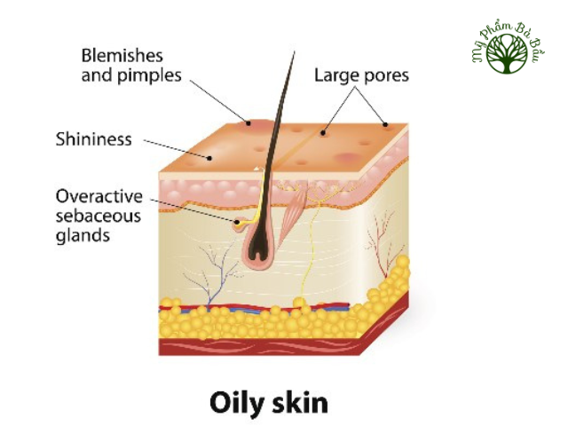 Làn da nhờn với tuyến bã nhờn được kích thích, sinh ra tình trạng bóng dầu, mụn trứng cá và lỗ chân lông lớn