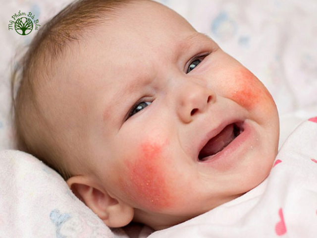 Vết chàm thường xuất hiện ở trên mặt, hai bên má của trẻ