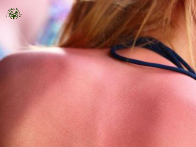 Cháy nắng là hiện tượng da bị tổn thương nặng khi da tiếp xúc quá mức với bức xạ ánh nắng mặt trời trong một thời gian dài