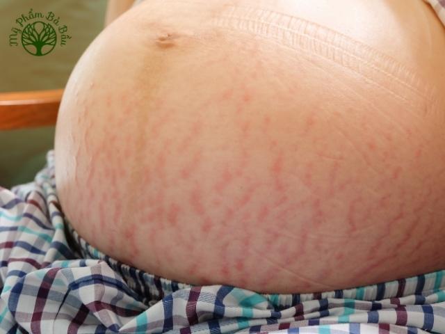 Rạn da là một trong những vấn đề thường gặp ở vùng da bụng của phụ nữ mang thai